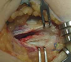 صورة توضيحية لـ علاج مرفق لاعب الغولف جراحياً: دليل شامل لتحرير التهاب اللقيمة الإنسية