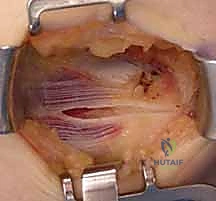 صورة توضيحية لـ علاج مرفق لاعب الغولف جراحياً: دليل شامل لتحرير التهاب اللقيمة الإنسية