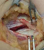 علاج مرفق لاعب الغولف جراحياً: دليل شامل لتحرير التهاب اللقيمة الإنسية