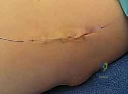 صورة توضيحية لـ علاج مرفق لاعب الغولف جراحياً: دليل شامل لتحرير التهاب اللقيمة الإنسية