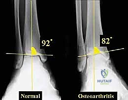 التشريح الميكانيكي لمفصل الكاحل وتوزيع الأحمال