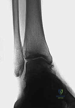 صورة توضيحية لـ جراحة قطع عظم الساق فوق الكاحل لعلاج خشونة مفصل الكاحل بتقنية الوتد المفتوح