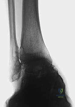 خيارات العلاج التحفظي والأجهزة التقويمية للكاحل