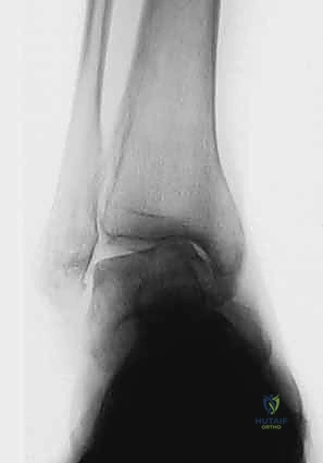 التقييم الإشعاعي المتقدم والتشخيص الدقيق للكاحل