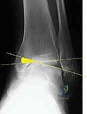 صورة توضيحية لـ جراحة قطع عظم الساق فوق الكاحل لعلاج خشونة مفصل الكاحل بتقنية الوتد المفتوح: دليل شامل مع الأستاذ الدكتور محمد هطيف