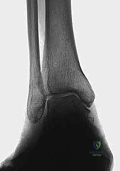 الأعراض السريرية ومؤشرات الألم في الكاحل التقوسي
