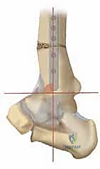 صورة توضيحية لـ جراحة قطع عظم الساق فوق الكاحل لعلاج خشونة مفصل الكاحل بتقنية الوتد المفتوح: دليل شامل مع الأستاذ الدكتور محمد هطيف