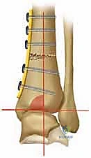 صورة توضيحية لـ جراحة قطع عظم الساق فوق الكاحل لعلاج خشونة مفصل الكاحل بتقنية الوتد المفتوح: دليل شامل مع الأستاذ الدكتور محمد هطيف