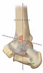 صورة توضيحية لـ جراحة قطع عظم الساق فوق الكاحل لعلاج خشونة مفصل الكاحل بتقنية الوتد المفتوح: دليل شامل مع الأستاذ الدكتور محمد هطيف