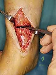 صورة توضيحية لـ جراحة قطع عظم الساق فوق الكاحل لعلاج خشونة مفصل الكاحل بتقنية الوتد المفتوح: دليل شامل مع الأستاذ الدكتور محمد هطيف