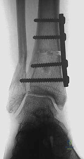 صورة طبية: جراحة قطع عظم الساق فوق الكاحل لعلاج خشونة مفصل الكاحل بتقنية الوتد المفتوح: دليل شامل مع الأستاذ الدكتور محمد هطيف