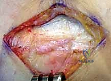 طرق العلاج التحفظي لمرفق التنس