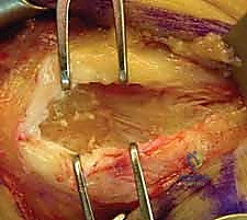 الفحص السريري الدقيق لمرفق التنس