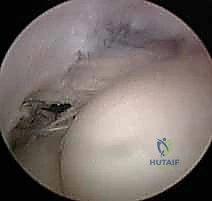 صورة توضيحية لـ مرفق التنس: الدليل الشامل لعلاج التهاب اللقيمة الوحشية مع الأستاذ الدكتور محمد هطيف