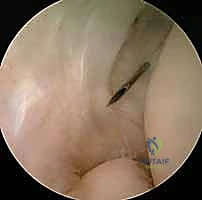 صورة توضيحية لـ مرفق التنس: الدليل الشامل لعلاج التهاب اللقيمة الوحشية مع الأستاذ الدكتور محمد هطيف