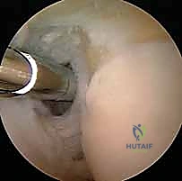 Illustration of treatment of lateral - Dr. Mohammed Hutaif