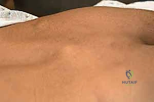 Illustration of arthrodesis for spondylolisthesis - Dr. Mohammed Hutaif