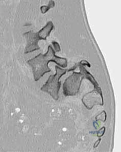 صورة توضيحية لـ تثبيت الفقرات الخلفي الجانبي للانزلاق الفقاري: دليل شامل للمرضى مع الأستاذ الدكتور محمد هطيف