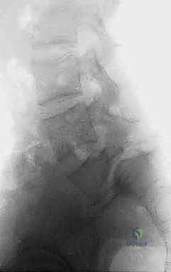 صورة توضيحية لـ تثبيت الفقرات الخلفي الجانبي للانزلاق الفقاري: دليل شامل للمرضى مع الأستاذ الدكتور محمد هطيف