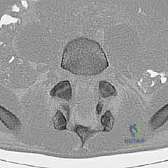 صورة توضيحية لـ تثبيت الفقرات الخلفي الجانبي للانزلاق الفقاري: دليل شامل للمرضى مع الأستاذ الدكتور محمد هطيف