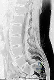 صورة توضيحية لـ تثبيت الفقرات الخلفي الجانبي للانزلاق الفقاري: دليل شامل للمرضى مع الأستاذ الدكتور محمد هطيف