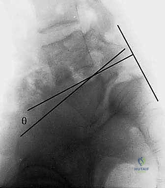 صورة توضيحية لـ تثبيت الفقرات الخلفي الجانبي للانزلاق الفقاري: دليل شامل للمرضى مع الأستاذ الدكتور محمد هطيف