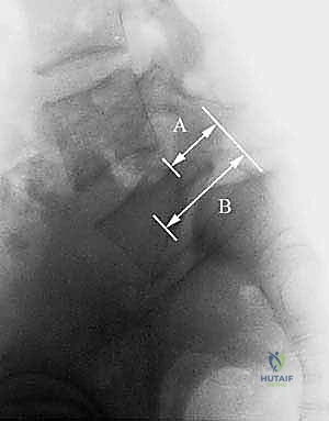 صورة توضيحية لـ تثبيت الفقرات الخلفي الجانبي للانزلاق الفقاري: دليل شامل للمرضى مع الأستاذ الدكتور محمد هطيف
