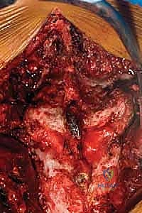 صورة توضيحية لـ تثبيت الفقرات الخلفي الجانبي للانزلاق الفقاري: دليل شامل للمرضى مع الأستاذ الدكتور محمد هطيف