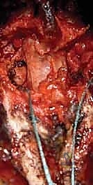 صورة توضيحية لـ تثبيت الفقرات الخلفي الجانبي للانزلاق الفقاري: دليل شامل للمرضى مع الأستاذ الدكتور محمد هطيف