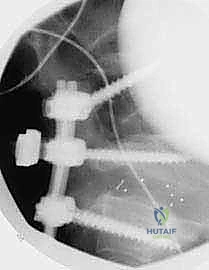 تثبيت الفقرات الخلفي الجانبي للانزلاق الفقاري: دليل شامل للمرضى مع الأستاذ الدكتور محمد هطيف