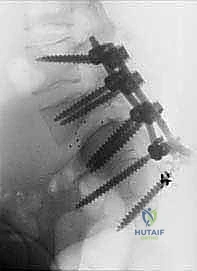 صورة توضيحية لـ تثبيت الفقرات الخلفي الجانبي للانزلاق الفقاري: دليل شامل للمرضى مع الأستاذ الدكتور محمد هطيف