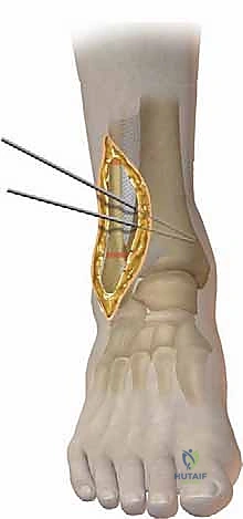 أسباب تشوهات الكاحل والتهاب المفاصل