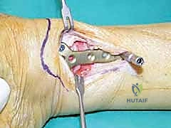 قطع العظم فوق الكاحل الحل الأمثل لتشوهات الكاحل وآلامه المزمنة