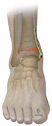 تثبيت العظم باستخدام الشرائح والمسامير