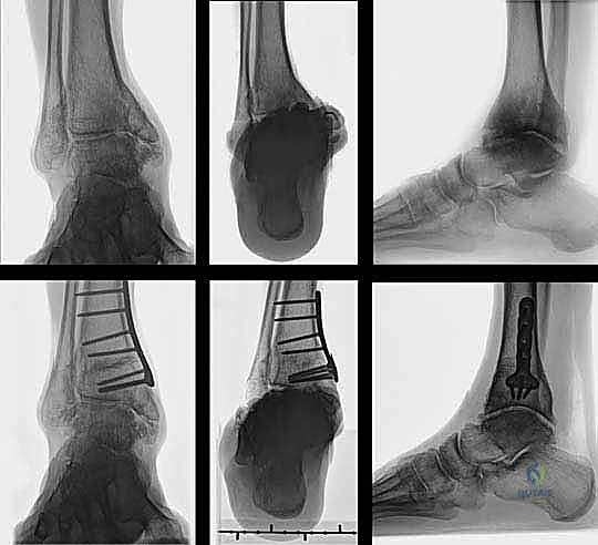 صورة توضيحية لـ قطع العظم فوق الكاحل الحل الأمثل لتشوهات الكاحل وآلامه المزمنة