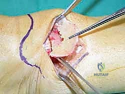 صورة توضيحية لـ قطع العظم فوق الكاحل الحل الأمثل لتشوهات الكاحل وآلامه المزمنة