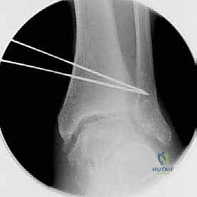 صورة توضيحية لـ قطع العظم فوق الكاحل الحل الأمثل لتشوهات الكاحل وآلامه المزمنة