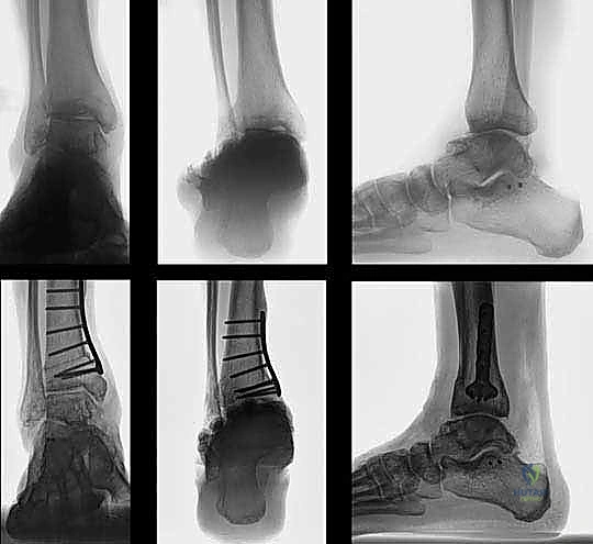 صورة توضيحية لـ قطع العظم فوق الكاحل الحل الأمثل لتشوهات الكاحل وآلامه المزمنة