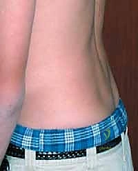 مخطط يوضح الضغط الميكانيكي على الجذور العصبية نتيجة الانزلاق