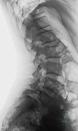 صورة ثلاثية الأبعاد توضح التآكل الغضروفي المصاحب للانزلاق