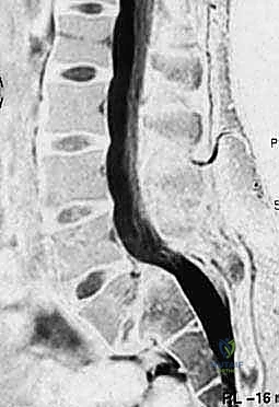 توضيح للخيارات العلاجية الجراحية في حالات الانزلاق المتقدم