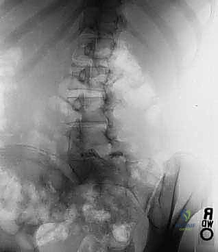 تحليل زوايا الانزلاق الفقاري لتحديد التدخل الجراحي المناسب