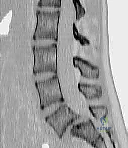 استخدام أحدث التقنيات الميكروسكوبية في جراحة العمود الفقري