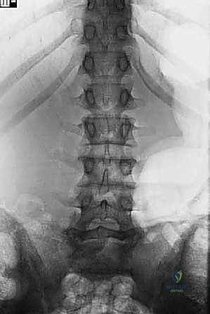 مقارنة بين عصب سليم وعصب مضغوط بسبب الانزلاق