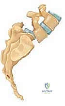 وضع الطعوم العظمية لتحفيز اندماج الفقرات