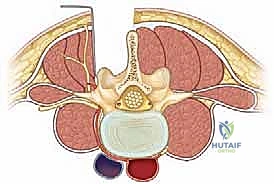 صورة توضيحية لـ علاج الانزلاق الفقاري عالي الدرجة: تخفيف الضغط والدمج الخلفي الجانبي ودمج الفقرات بين الأجسام الفقرية مع الأستاذ الدكتور محمد هطيف في صنعاء