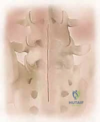 صورة توضيحية لـ علاج الانزلاق الفقاري عالي الدرجة: تخفيف الضغط والدمج الخلفي الجانبي ودمج الفقرات بين الأجسام الفقرية مع الأستاذ الدكتور محمد هطيف في صنعاء