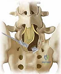 إدخال القفص الداعم (Cage) بين الأجسام الفقرية