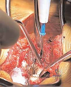 صورة توضيحية لـ علاج الانزلاق الفقاري عالي الدرجة: تخفيف الضغط والدمج الخلفي الجانبي ودمج الفقرات بين الأجسام الفقرية مع الأستاذ الدكتور محمد هطيف في صنعاء