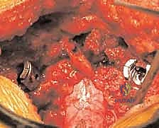 صورة توضيحية لـ علاج الانزلاق الفقاري عالي الدرجة: تخفيف الضغط والدمج الخلفي الجانبي ودمج الفقرات بين الأجسام الفقرية مع الأستاذ الدكتور محمد هطيف في صنعاء